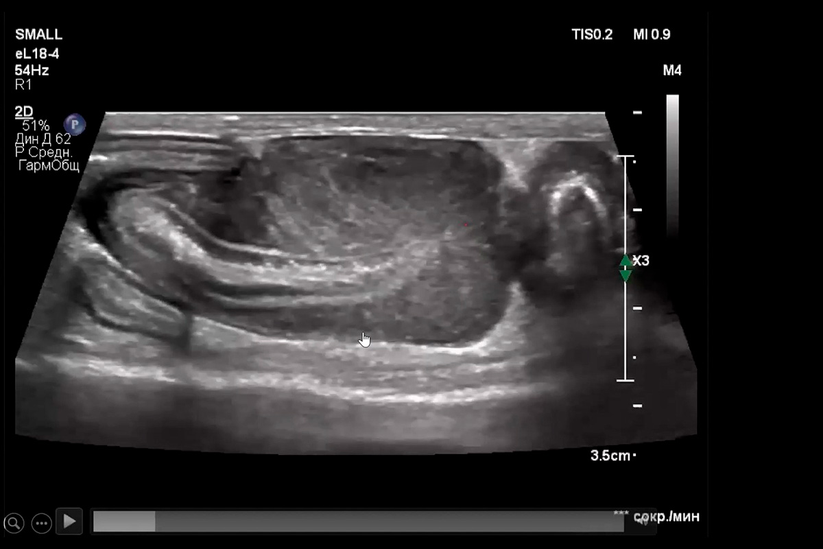 Ультразвуковые находки при хронических энтеропатиях